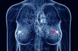 Brevettati geni cancro al seno e ovaie: lo studio rallenta, anzi, si ferma