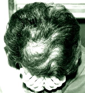Calvizie androgenetica: i numeri e le soluzioni