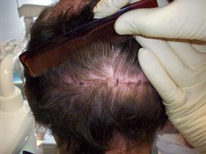 Calvizie: trapianto di capelli