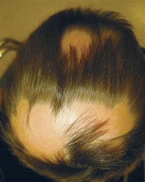 Che cos'� l'alopecia areata?