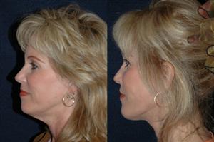 Collo grinzoso e rugoso? Scegli il neck lifting