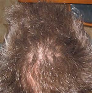 Differenza tra calvizie e caduta dei capelli