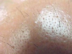 Hair Multiplication: rigenerazione del capello