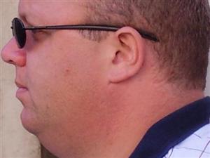 Liposuzione per eliminare il doppio mento
