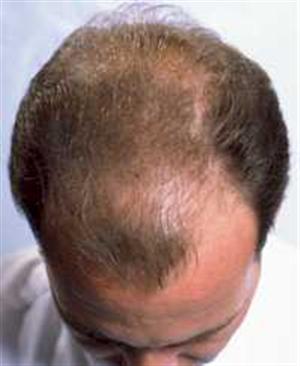 Nascondi la calvizie con Derm Match