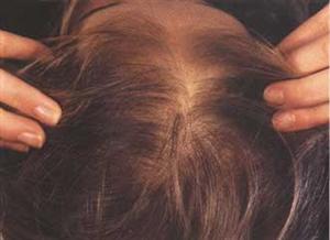 Telogen effluvium? Una delle principali cause dell'alopecia