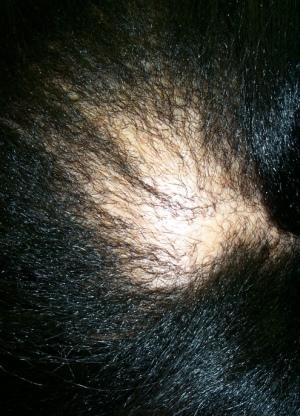 Un nuovo approccio al trattamento dell'alopecia cicatriziale