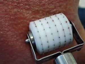Un viso pi� giovane a costi contenuti con il needling